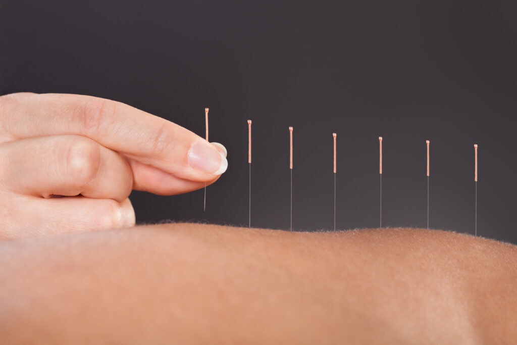 Exploring the Synergy Between Acupuncture and Chiropractic Care